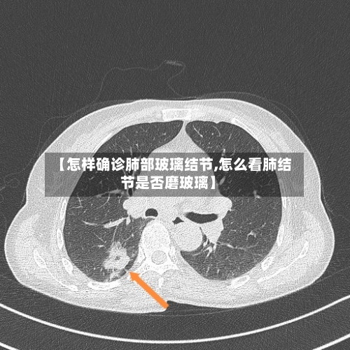【怎样确诊肺部玻璃结节,怎么看肺结节是否磨玻璃】-第2张图片