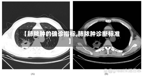 【肺脓肿的确诊指标,肺脓肿诊断标准】