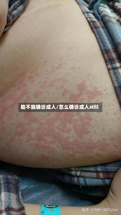 能不能确诊成人/怎么确诊成人still-第2张图片