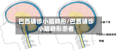 巴西确诊小脑畸形/巴西确诊小脑畸形患者