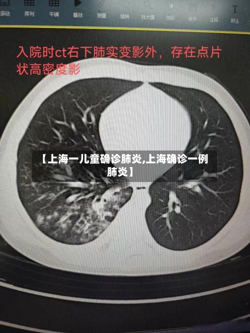 【上海一儿童确诊肺炎,上海确诊一例肺炎】