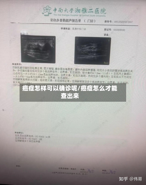 癌症怎样可以确诊呢/癌症怎么才能查出来