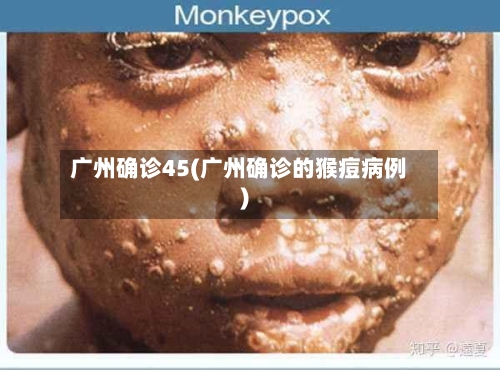 广州确诊45(广州确诊的猴痘病例)