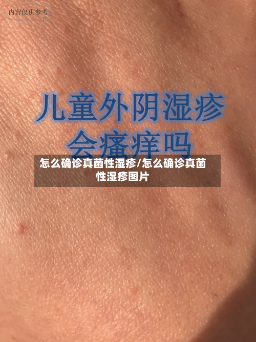 怎么确诊真菌性湿疹/怎么确诊真菌性湿疹图片