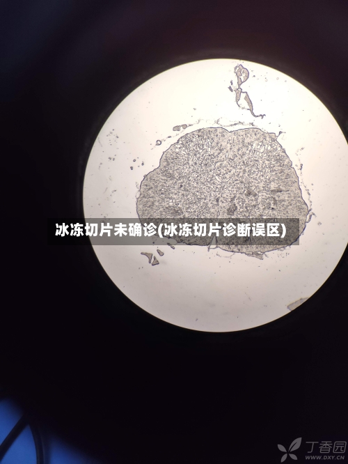 冰冻切片未确诊(冰冻切片诊断误区)-第3张图片