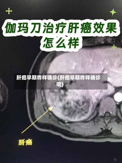 肝癌早期咋样确诊(肝癌早期咋样确诊呢)